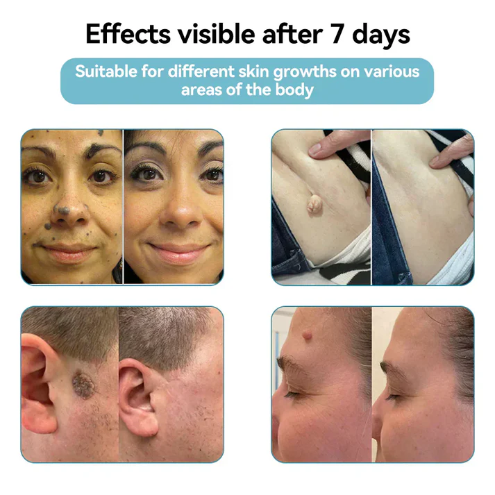 Thekoec® All-in-One CO₂ Laser Eraser Pen | Removes Moles, Warts, Skin Flaws & Pigmentation