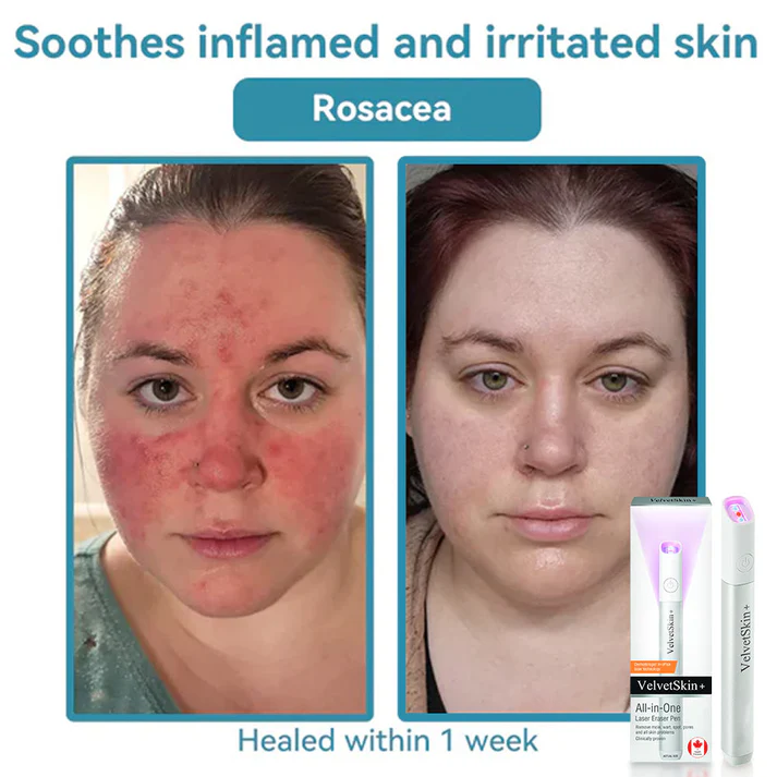 Thekoec® All-in-One CO₂ Laser Eraser Pen | Removes Moles, Warts, Skin Flaws & Pigmentation