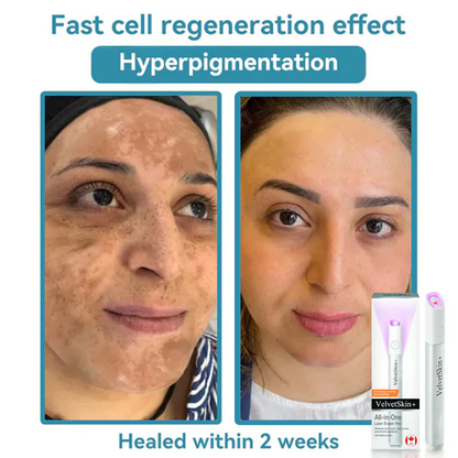Thekoec® All-in-One CO₂ Laser Eraser Pen | Removes Moles, Warts, Skin Flaws & Pigmentation