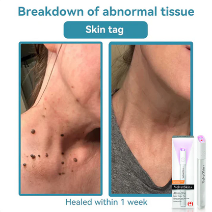 Thekoec® All-in-One CO₂ Laser Eraser Pen | Removes Moles, Warts, Skin Flaws & Pigmentation